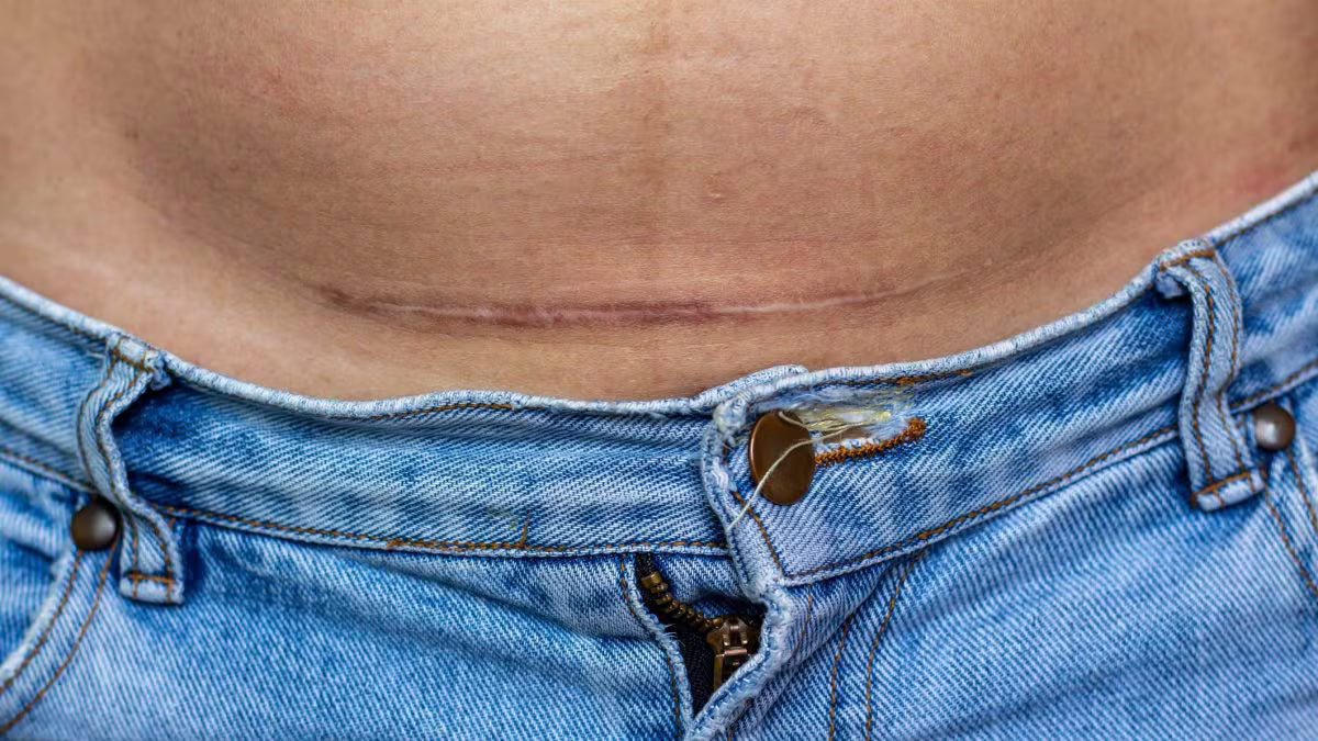 Prendersi cura della cicatrice da parto cesareo